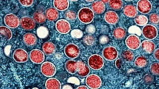Mpox: Suécia regista primeiro caso de nova variante
