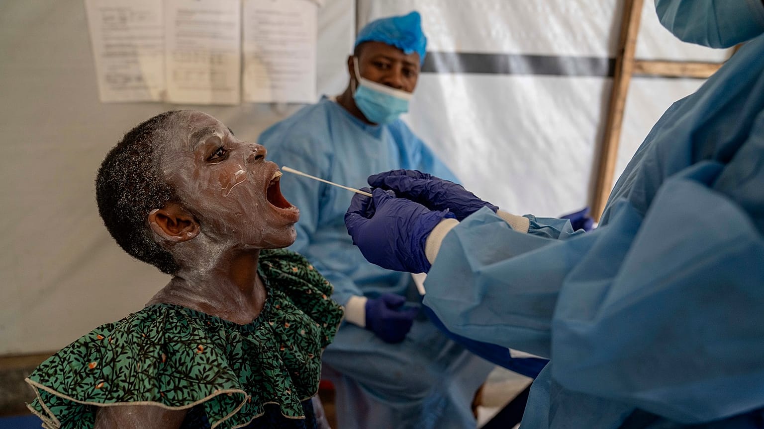A health worker takes a saliva sample from Lucie Habimana, 13, a mpox patient, at a treatment centre in Munigi, eastern Congo, Friday, August 16, 2024.