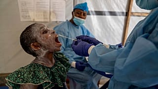 A health worker takes a saliva sample from Lucie Habimana, 13, a mpox patient, at a treatment centre in Munigi, eastern Congo, Friday, August 16, 2024.
