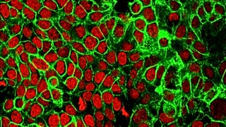 FILE - This microscope image made available by the National Cancer Institute Center for Cancer Research in 2015 shows human colon cancer cells with the nuclei stained red.