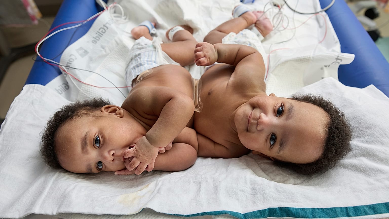 Questa foto fornita dall'Ospedale pediatrico di Filadelfia mostra i due gemelli coniugati Amari e Javar Ruffin all'Ospedale pediatrico di Filadelfia, il 20 marzo 2024.