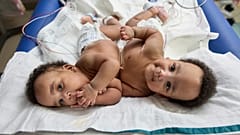 Imagen de los gemelos unidos, Amari y Javar Ruffin, en el Hospital Infantil de Filadelfia, el 20 de marzo de 2024.