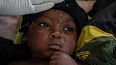 Un niño de dos años con la viruela del mono, ingresado en un hospital en Kamituga, provincia de Kivu del Sur.