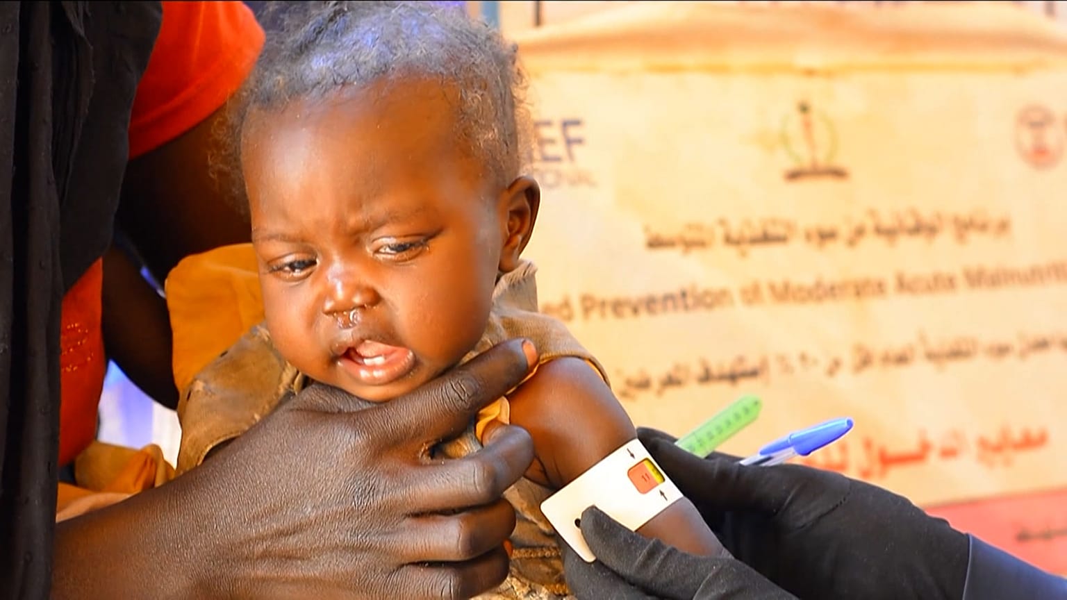 Zamzam kampında yetersiz beslenen çocuk, Sudan, 22.11.2024