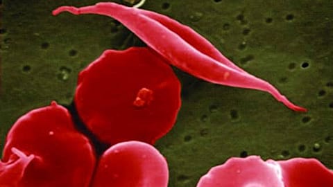 This electron microscope image provided by the National Institutes of Health in 2016 shows a blood cell altered by sickle cell disease, top.