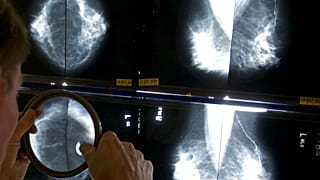 DOSSIER - Un radiologue utilise une loupe pour vérifier la présence d'un cancer du sein sur des mammographies à Los Angeles.