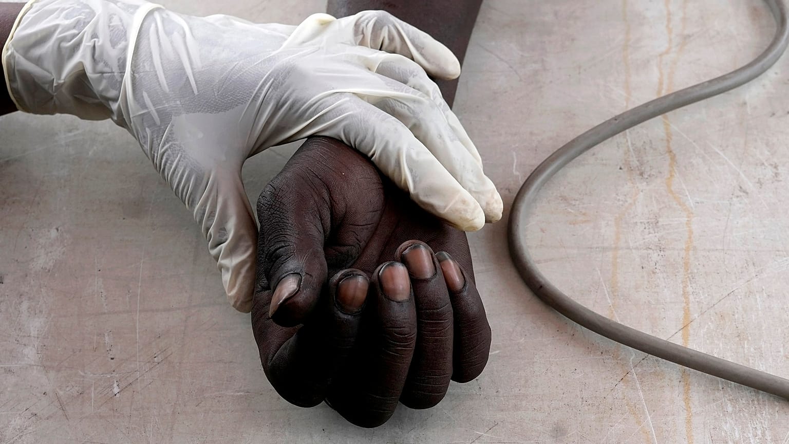 Un drogadicto en una revisión médica de un programa de intercambio de jeringuillas antes de recibir una nueva jeringuilla estéril, en las afueras de Pretoria, Sudáfrica.