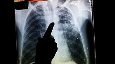 Ezen a 2013-as aktaképen egy brit radiológus egy tuberkulózisos betegről készült röntgenfelvételre mutat.