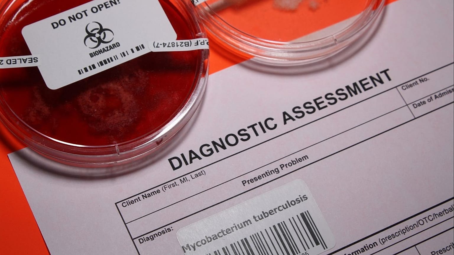 São apresentadas amostras médicas para testar a tuberculose.