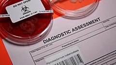 São apresentadas amostras médicas para testar a tuberculose.