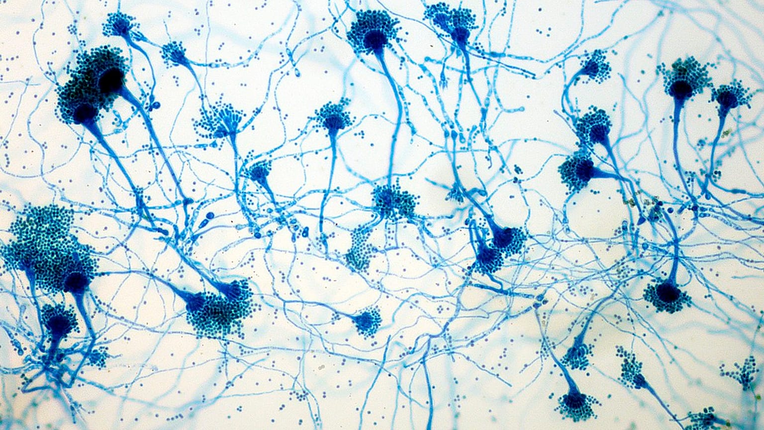 Kritik derecede hasta bir hastadan alınan solunum örneğinden Aspergillus hifleri
