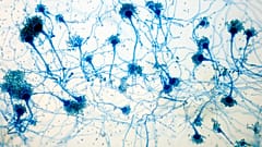Kritik derecede hasta bir hastadan alınan solunum örneğinden Aspergillus hifleri