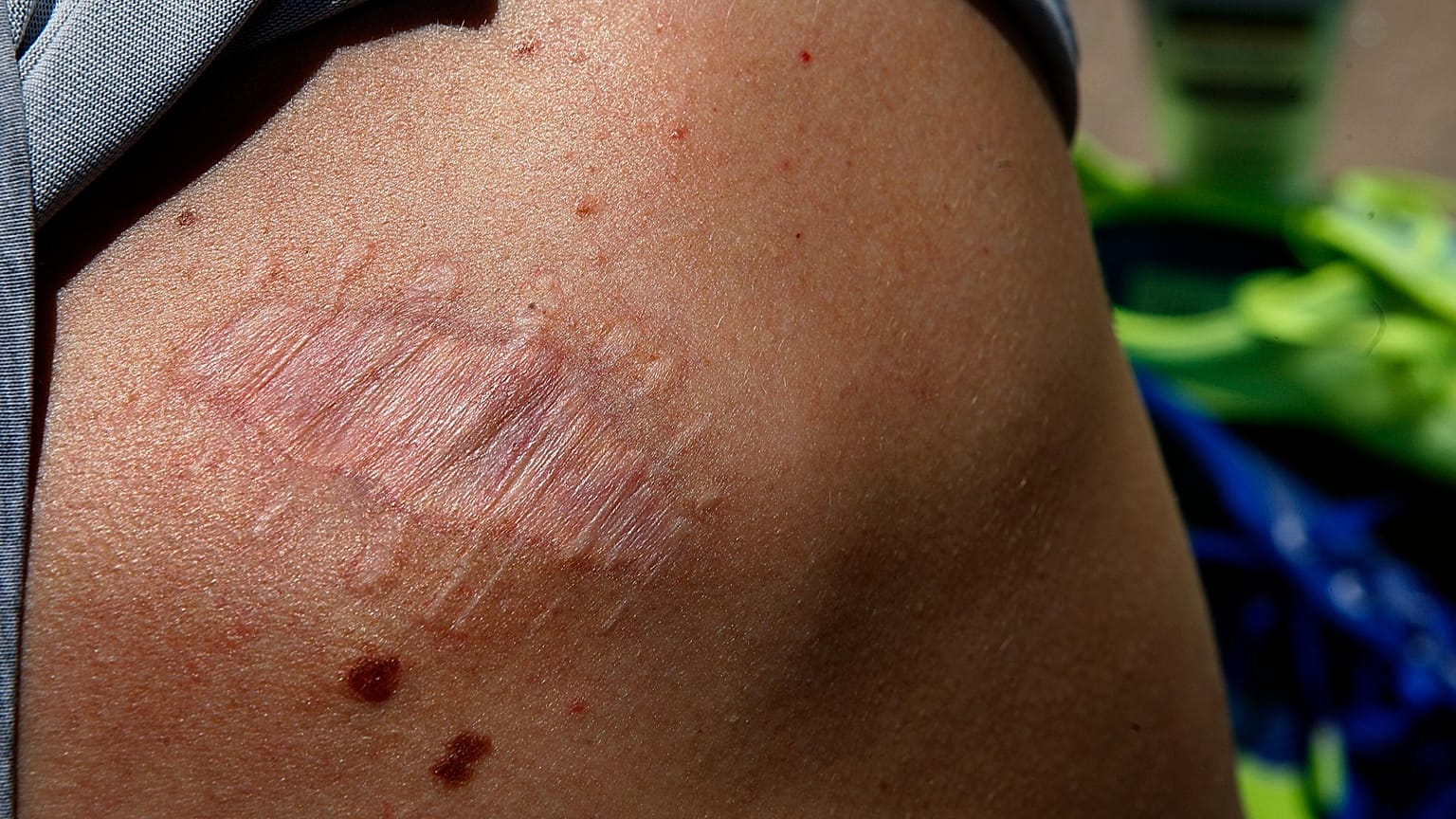 Eine Narbe nach einer Hautkrebsoperation. Die Krankenhausaufenthalte aufgrund von Hautkrebs haben sich in Deutschland binnen 20 Jahren verdoppelt.