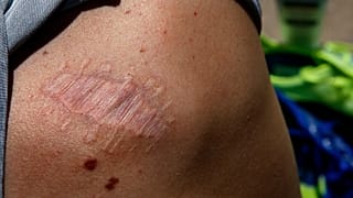 Eine Narbe nach einer Hautkrebsoperation. Die Krankenhausaufenthalte aufgrund von Hautkrebs haben sich in Deutschland binnen 20 Jahren verdoppelt.