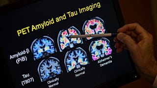نتائج فحص التصوير المقطعي التي تشكل جزءًا من دراسة حول مرض الزهايمر في مستشفى جامعة جورج تاون في واشنطن، 19 مايو/أيار 2015