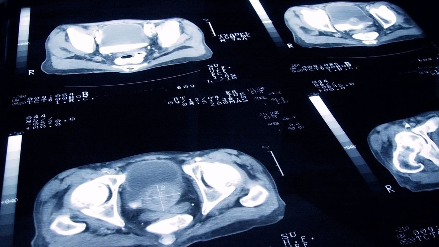Se muestran diapositivas de cáncer de próstata.