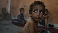 Yazan Abu Ful, ein zweijähriges unterernährtes Kind