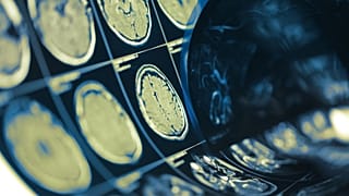 Brain scans are shown.