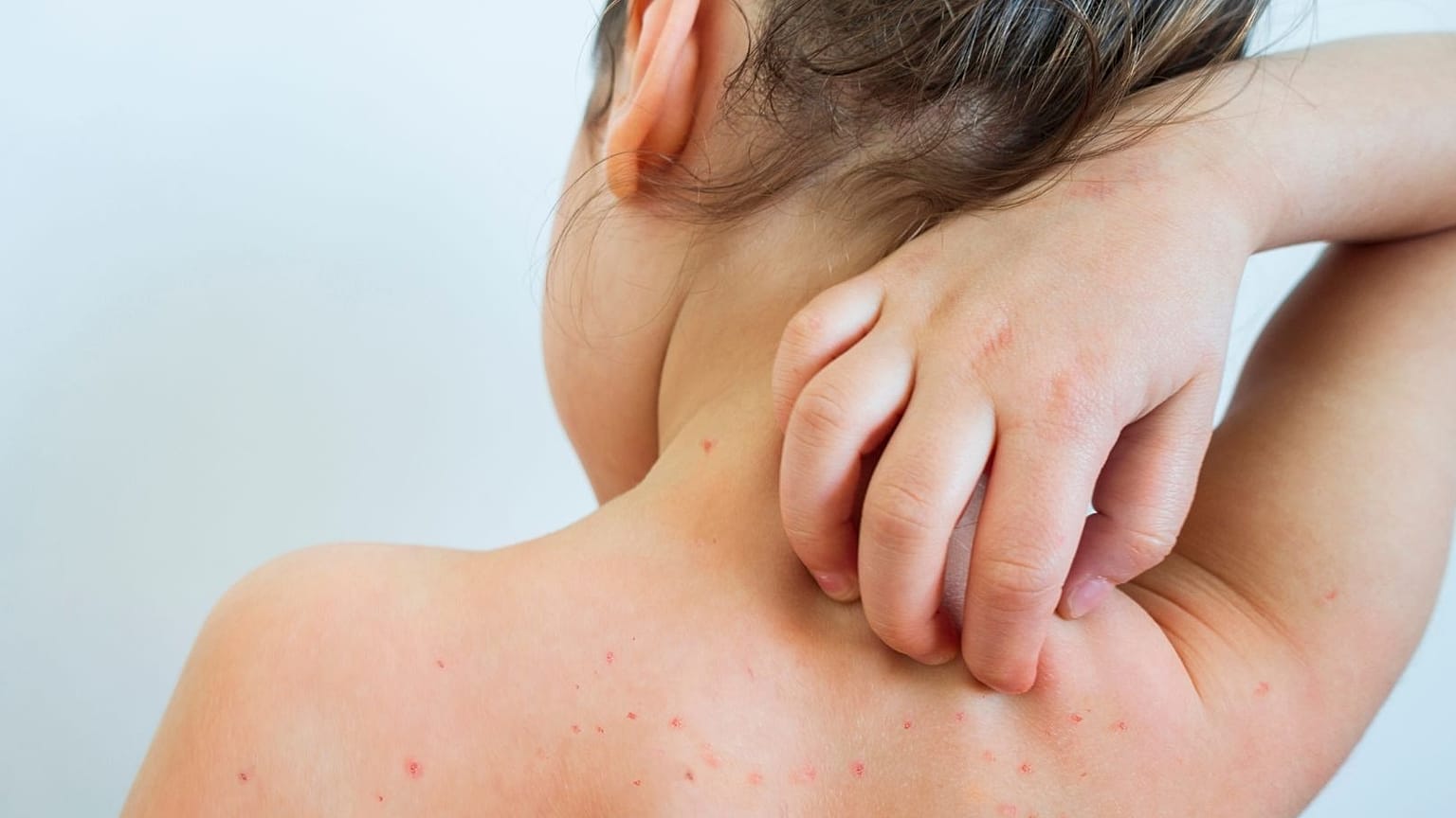 A child has chickenpox.