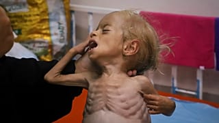 شام، البالغة عامين، تعاني من سوء تغذية حاد، في مستشفى ناصر بخان يونس جنوب غزة، 9 أغسطس 2025.