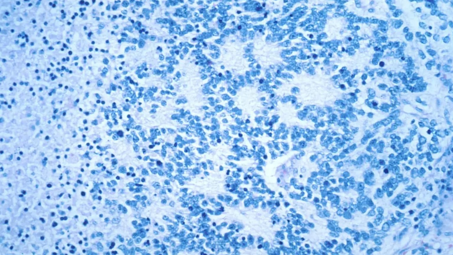 Células cancerosas al microscopio