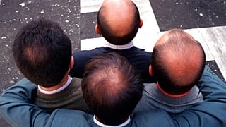 صورة من الأرشيف- أربع رجال في روما يعرضون تفاوت تساقط شعرهم