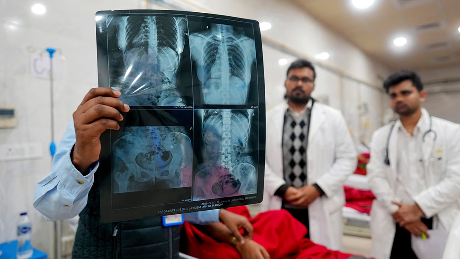 صورة تعبيرية لأطباء يفحصون صورة بالأشعة السينية أثناء علاج مصاب في مستشفى موتيلال نهرو في براياجراج، الهند