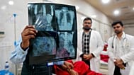 صورة تعبيرية لأطباء يفحصون صورة بالأشعة السينية أثناء علاج مصاب في مستشفى موتيلال نهرو في براياجراج، الهند