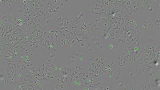 Imagen de células tumorales atacadas por la bacteria del cólera