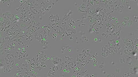 Image of tumour cells attacked by cholera bacteria