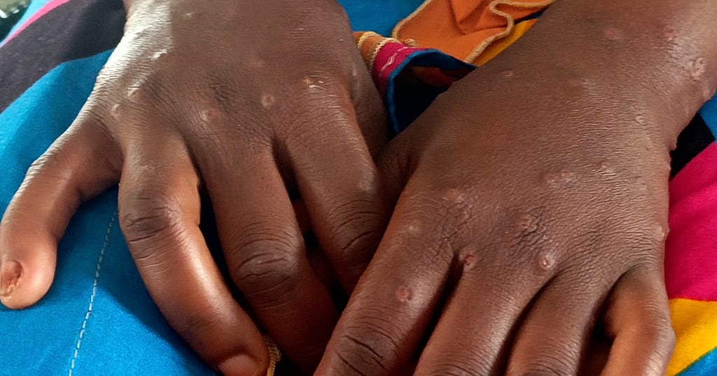 WHO reports rapid spread of Mpox with 17 deaths in Africa over recent weeks WHO reports rapid spread of Mpox with 17 deaths in Africa over recent weeks