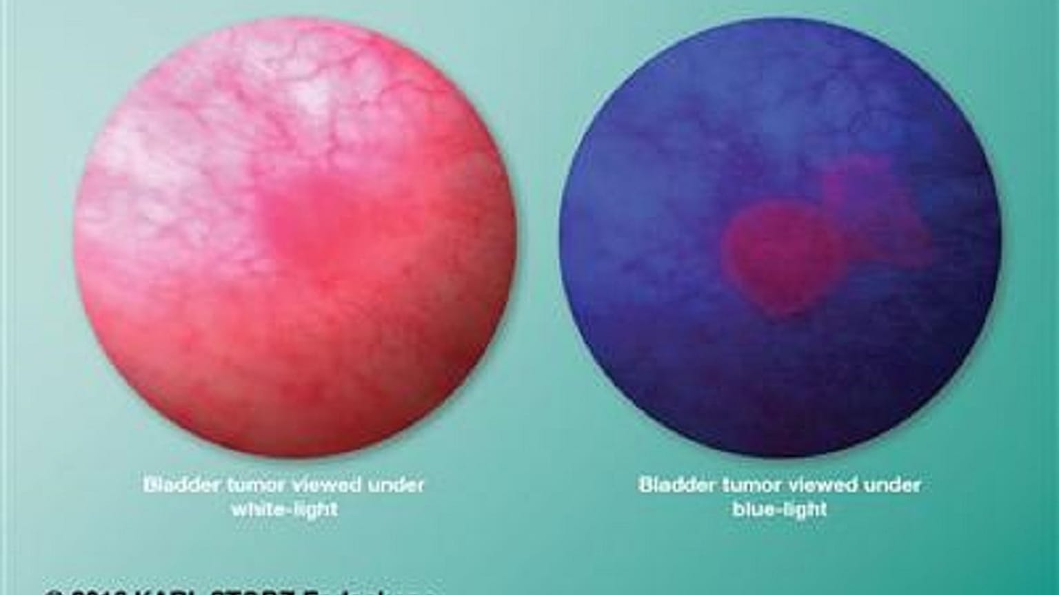  يوفر تنظير المثانة بالضوء الأزرق مع تقنية Cysview حلاً للكشف المعزز عن سرطان المثانة غير العضلي الغازي وإدارته، كما هو موضح في هذه الصورة. 