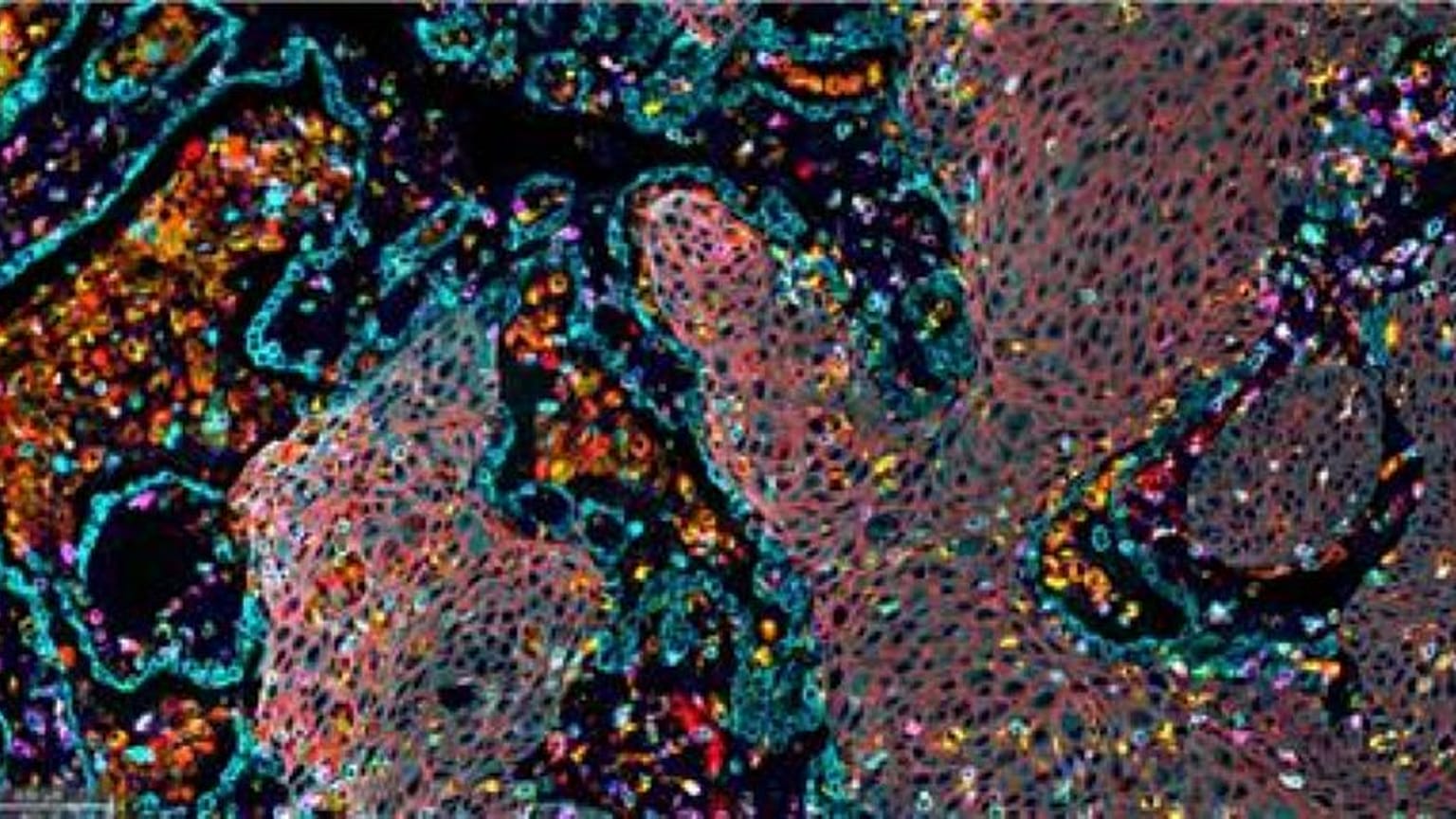 صورة مناعية فلورية متعددة تُظهر تسللات مناعية في عينة سرطان الرئة ذي الخلايا غير الصغيرة