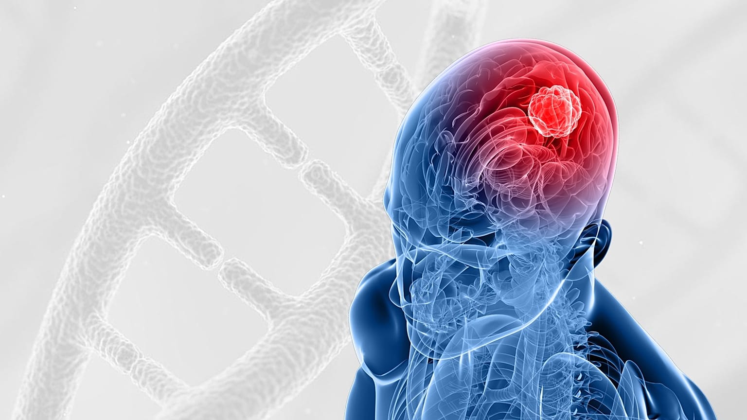 صورة توضيحة لسرطان الدماغ