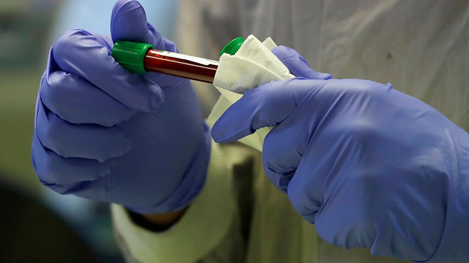 عينة دم من متطوع في مختبر إمبريال كوليدج بلندن، الخميس 30 يوليو 2020.