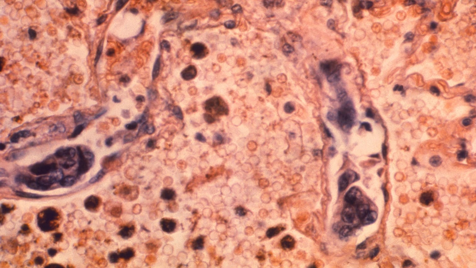 تُظهر هذه الصورة المأخوذة بواسطة المجهر عام 1964، والتي أتاحتها مراكز السيطرة على الأمراض والوقاية منها، عينة من نسيج الرئة لمريض مصاب بسرطان غدي في الرئة.