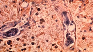 تُظهر هذه الصورة المأخوذة بواسطة المجهر عام 1964، والتي أتاحتها مراكز السيطرة على الأمراض والوقاية منها، عينة من نسيج الرئة لمريض مصاب بسرطان غدي في الرئة.