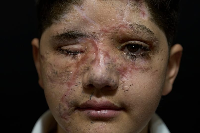 علي عباس، 11 عامًا، الذي جُرح في هجمات أجهزة النداء (البيجر) التي نفذتها إسرائيل في 17 سبتمبر 2024، يلتقط صورة في قرية باريش الجنوبية في لبنان، 28 أبريل 2025.