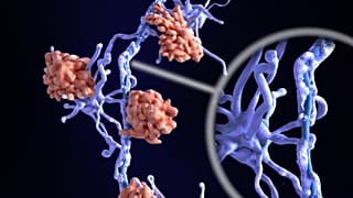 Sclerosis multiplex által érintett ideg sigma jt??