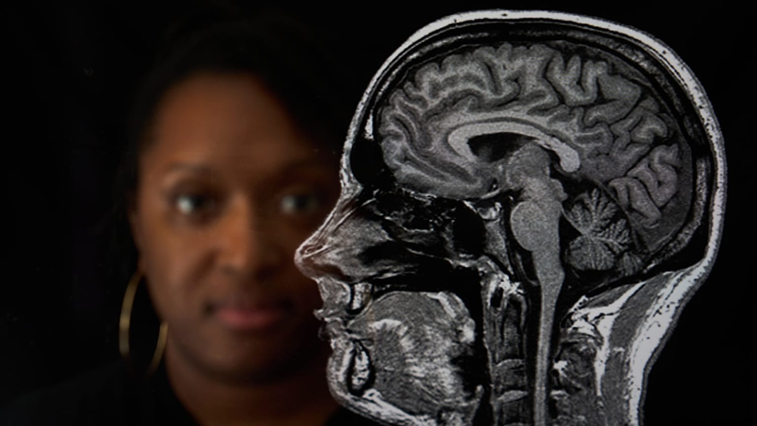 ًصورة لمسح دماغ مصابة