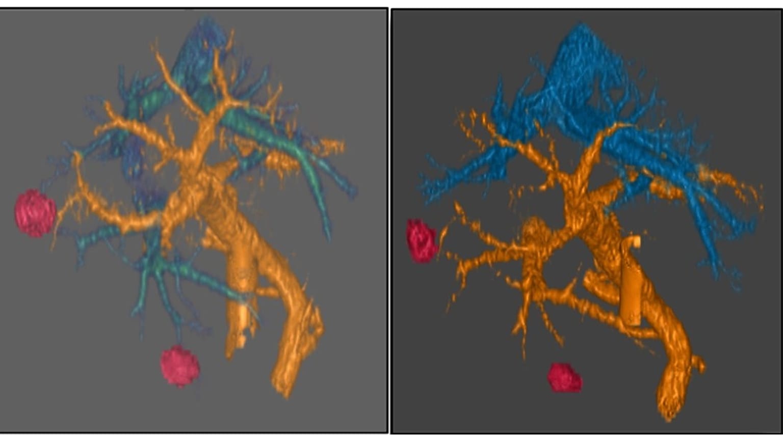 اختبر الدكتور مصطفى رؤوف وفريقه نهجًا مبتكرًا على مريضين لم تستجب أورام البنكرياس لديهما للعلاجات السابقة. (حقوق الصورة: الدكتور مصطفى رؤوف / مدينة الأمل)
