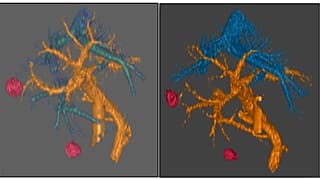 اختبر الدكتور مصطفى رؤوف وفريقه نهجًا مبتكرًا على مريضين لم تستجب أورام البنكرياس لديهما للعلاجات السابقة. (حقوق الصورة: الدكتور مصطفى رؤوف / مدينة الأمل)