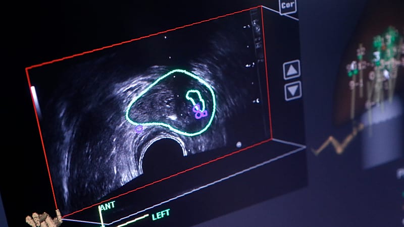 ابتكار طبي يوظف الذكاء الاصطناعي لمراقبة سرطان البروستاتا.. كيف سيؤثر على رعاية المرضى؟ 