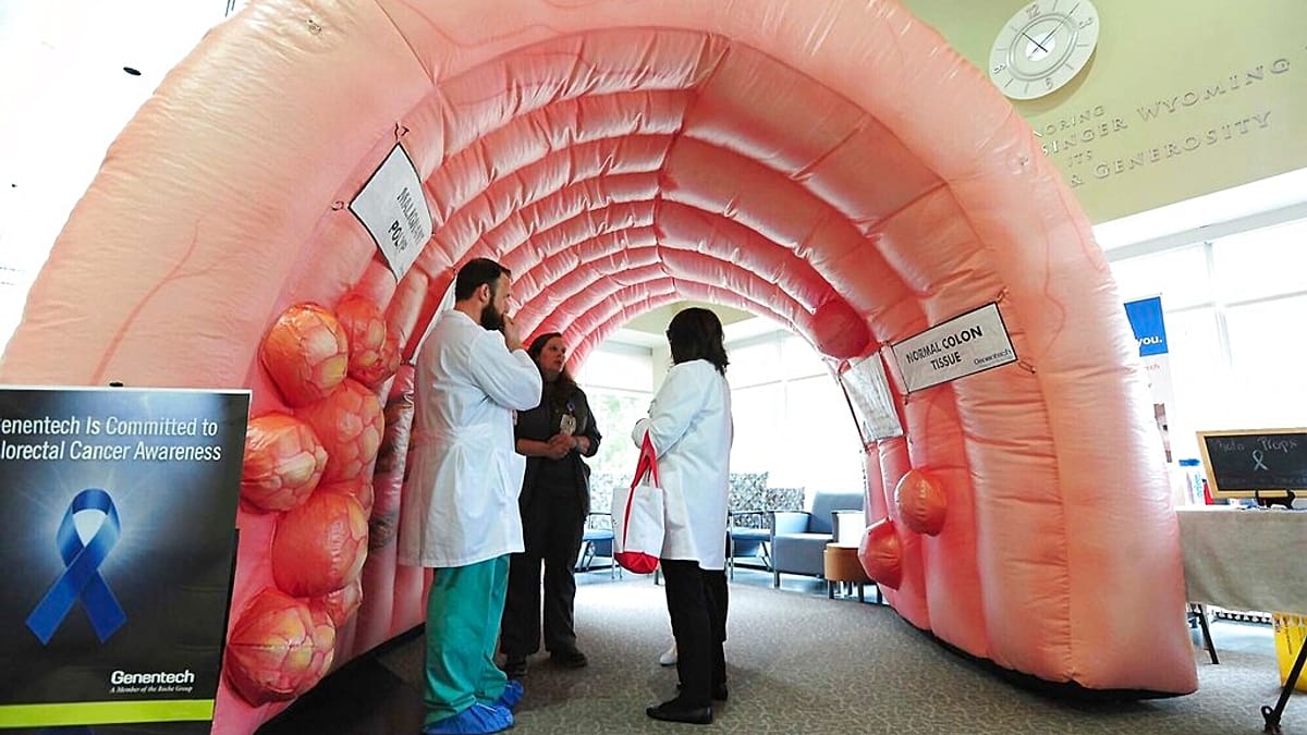 Early Colorectal Cancer Risk Linked to Inflammatory Bowel Disease Study