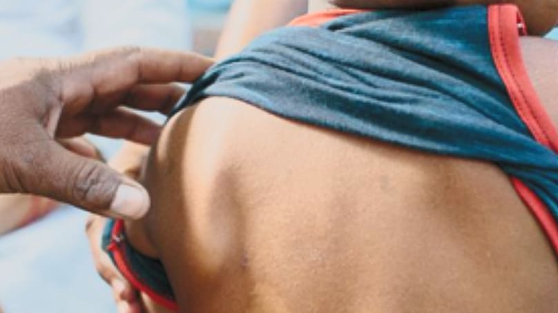 Lepra-gyanús gyerek vizsgálata Malawiban