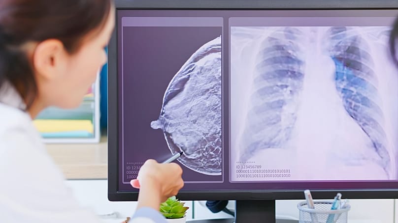 طبية تعرض صور أشعة، بينها صورة للثدي وأخرى للصدر.