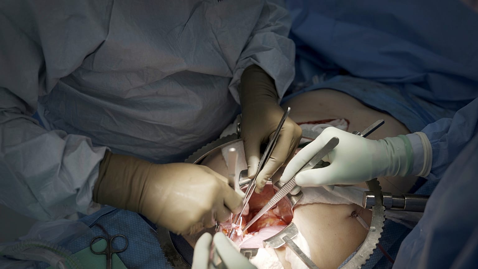 Chirurghi al lavoro su un trapianto di rene negli Stati Uniti nel 2023