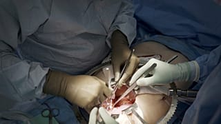 Chirurghi al lavoro su un trapianto di rene negli Stati Uniti nel 2023