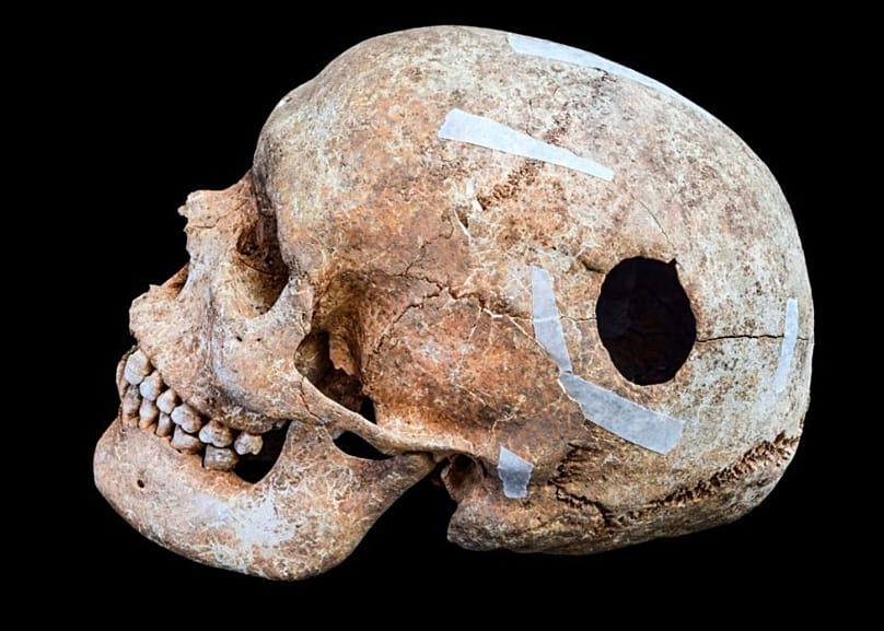 Auf der hinteren linken Seite des Schädels befindet sich ein ovales, rund drei Zentimeter großes Loch.