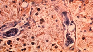 تُظهر هذه الصورة المجهرية لعام 1964، التي أتاحتها مراكز السيطرة على الأمراض والوقاية منها (CDC)، عينة من نسيج الرئة لمريض مصاب بسرطان الغدة (أدينوكارسينوما) في الرئة.